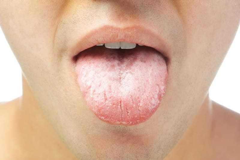 혀 백태 없애는 법 5가지